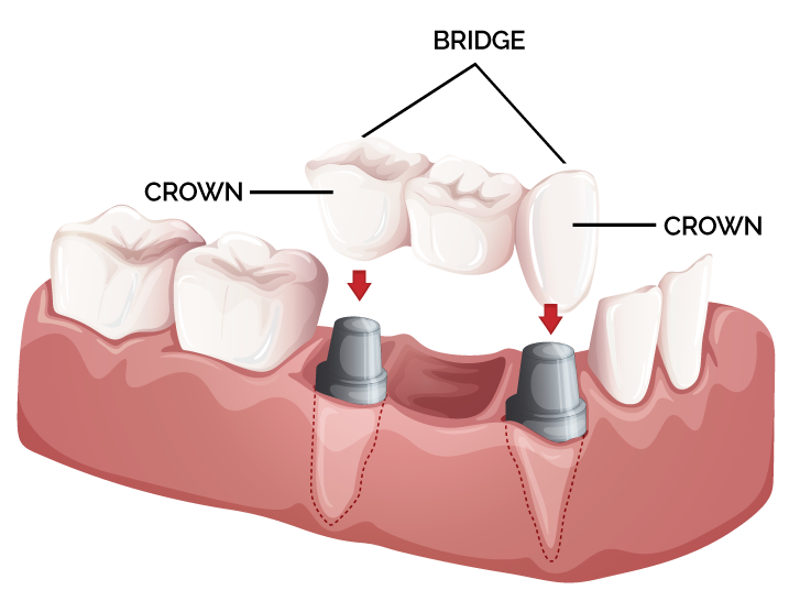 Are Dental Crowns and Bridges Right for Me?