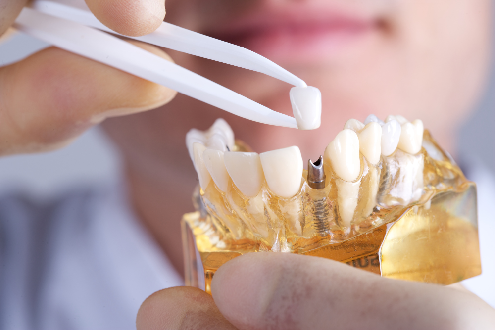Dental Implants for People with Gum Disease