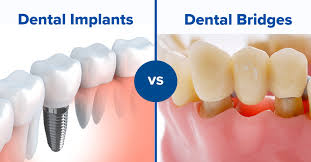 Dental Bridge vs. Dental Implant: Choosing the Right Tooth Replacement