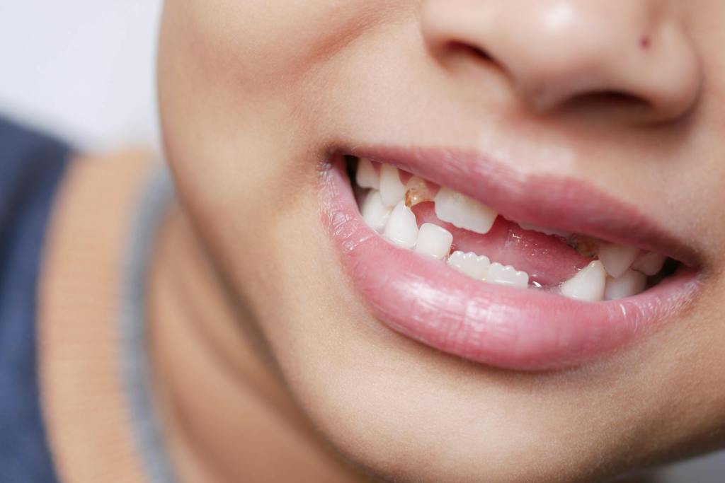 What Can You Do for Missing Teeth?